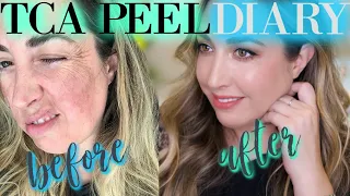 TCA Peel Diary | Before and After | Chemical Peel at HOME