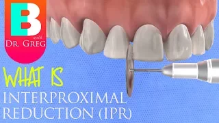 Interproximal Reduction (IPR) Stripping of Teeth for Braces or Invisalign