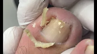 Best way to keep away from ingrown nails