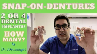 2 or 4 Dental Implants for Snap-on-Dentures? How to Decide?