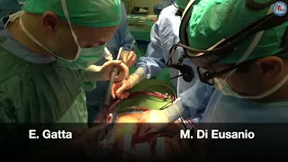 Normothermic frozen elephant trunk surgery without circulatory arrest: how we do it in Ancona