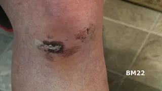 Knee Surgery Unwrapping: 3 days after meniscus surgery
