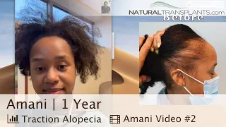 Traction Alopecia Hair Loss is Treatable with Hair Restoration Surgery | Dr Harold Siegel (Amani)