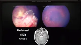 Retinoblastoma Pathology - Dr. Brenda Gallie