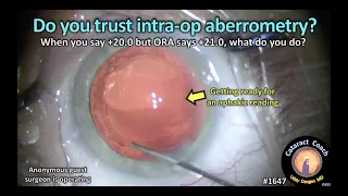 CataractCoach 1647: do you trust intra-op aberrometry?