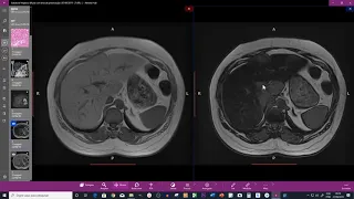 ESTEATOSE HEPÁTICA COM ÁREA DE PRESERVAÇÃO