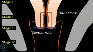 FIGO staging of cervical cancer 2018