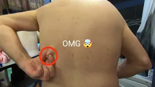 Insane Back Pimple Bursting Extravaganza