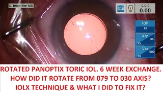 Rotated Panoptix Toric IOL. Six Week Postop IOL Exchange Technique & What I Did to Fix It.