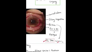 Acute Postoperative Endophthalmitis - Case Discussion In A Minute #Mustknow #Shorts