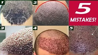 5 Mistakes in a freshly transplanted Hairline!!!