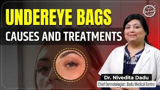 How to get rid of Under Eye Bags or Puffy Eyes? | Under Eye Bags से छुटकारा कैसे पाएं | DMC
