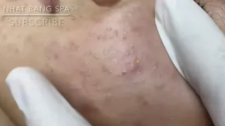 Satisfying and relaxing blackheads, pimple pop - Nhat Bang Acne Treatment - Chuyen Nguyen Spa #25