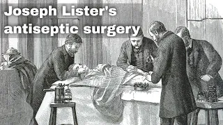 12th August 1865: Joseph Lister conducts the world’s first antiseptic surgery using carbolic acid