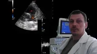 Pediatric Cardiac ultrasound (echocardiography) - patent ductus arteriosus (PDA)