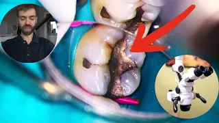 The SAFE WAY to remove Silver Mercury Fillings (Amalgam)