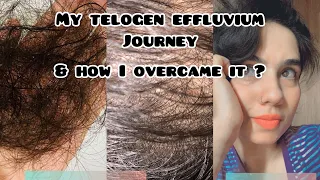 I was bald after dengue fever | Understanding telogen effluvium #telogeneffluviumrecovery