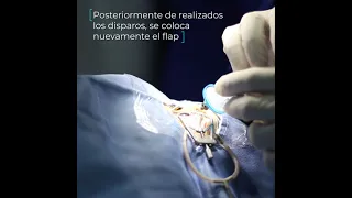 Cirugía refractiva Femto Lasik - Clínica VIDAVA'S Chiclayo