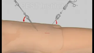 Railroading - Laparoscopic Surgery Basics- AV Hospital