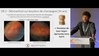 Dr Romain Jaillant aux JRO - Urgences ophtalmologiques et traumatologie de ville  - Daviel SOS Oeil