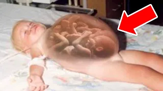 Baby Boy Born Pregnant with Twins and doctors were left speechless!