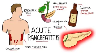 Acute Pancreatitis - Causes, Signs & Symptoms, Pathophysiology, Diagnosis