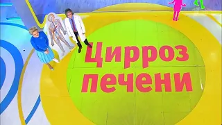 Лечение асцита при циррозе печени (ТИПС)