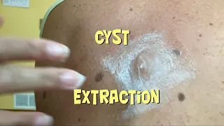 Pimple Popping a Cyst