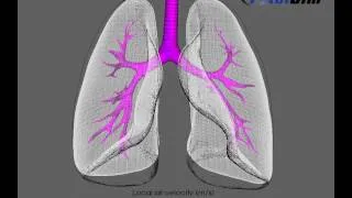 CFD simulation of expanding lungsTotalsim | TotalSim | Experts in CFD