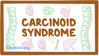 Carcinoid Syndrome - causes, symptoms, diagnosis, treatment, pathology