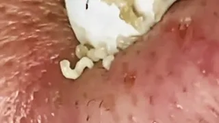 WOOW !! BEAUTY OF SQUEEZE😨 BLACKHEADS REMOVAL FROM THE NOSE #2 #relaxing  #blackheads