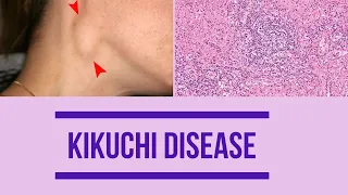 Kikuchi disease | Factors | Clinical features | Diagnosis | histopathology | Management