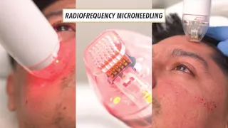 Radiofrequency Microneedling Treatment by Dr. Nadir Qazi