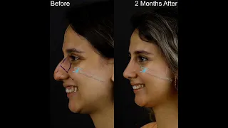 Big Change with Rhinoplasty | Before And 2 Months After