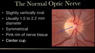 Glaucomatous Optic Disc Changes , Dr.Saad Alshamrani