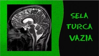 Videoaula e dicas em Radiologia - Ressonância Magnética - Sela turca vazia