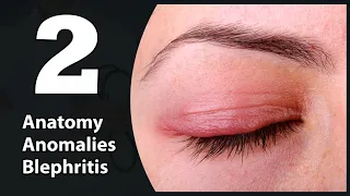 2- Eye lids (Anatomy, Congenital anomalies & Blephritis)