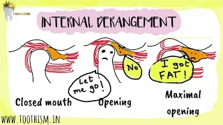 INTERNAL DERANGEMENT |Anterior Disk Displacement - Temporomandibular Joint