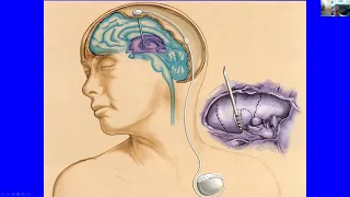 Advances in neurosurgery: A new trial for frontotemporal dementia