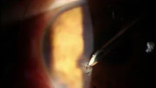 Cornea Metal Foreign Body Removal from Eye and Rust Burr