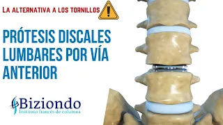 ▷▷Cirugía de columna lumbar sin tornillos: Prótesis discales lumbares por vía abdominal | Biziondo