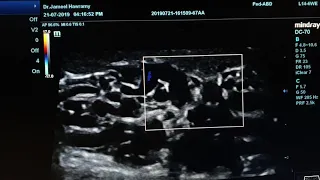 Varicocele with Reflux Sonography