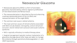 Lecture: Neovascular Glaucoma (1 Slide in 5 Minutes)
