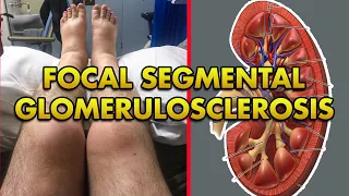 Focal Segmental Glomerulosclerosis: Pathophysiology, Signs and Symptoms, Diagnosis and Treatment