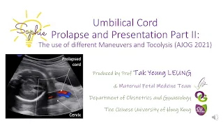 Umbilical CordProlapse and Presentation Part II:The use of different Maneuvers and Tocolysis