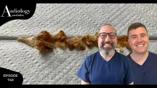 TIGHTLY PACKED HARD SKIN REMOVAL FROM EAR - EP740