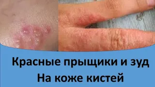 Красные прыщики и зуд на кистях