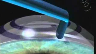 Corneal Ring Surgical Technique.wmv