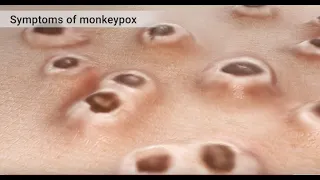 Mpox (Monkeypox) Animation