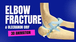 Elbow (Olecranon) Fracture and Fixation - 3D Animation